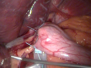 Общий вид после операции : бандажирование желудка шаг 13_b  : желудочный бандаж Bioring