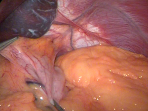 Отведение желудка : бандажирование желудка шаг 2  : желудочный бандаж Bioring
