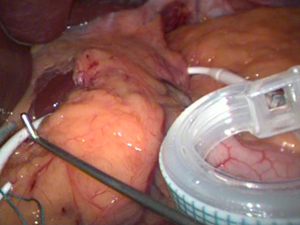 Выведение трубки : бандажирование желудка шаг 9  : желудочный бандаж Bioring